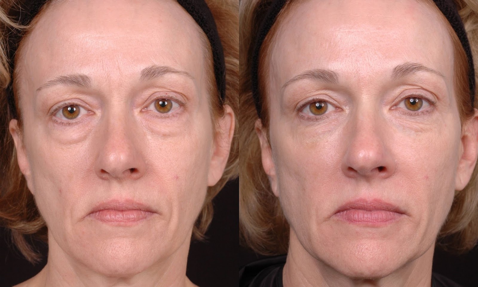 Juvederm for under Eye Bags before and after